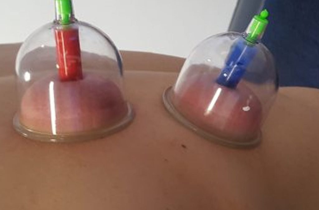 Cupping Therapy – How it looks