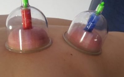Cupping Therapy – How it looks